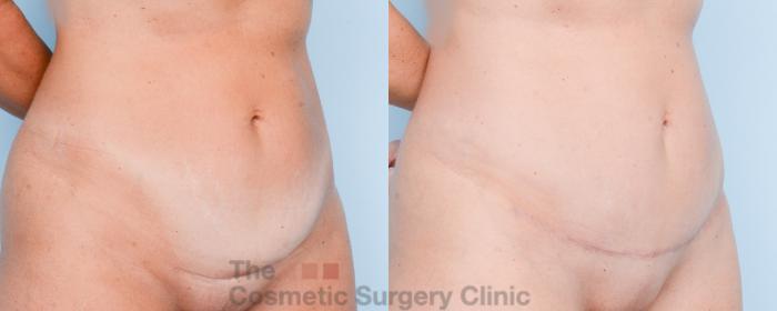 Before & After Mini-Tummy Tuck Case 867 Right Oblique View in Waterloo, Ontario