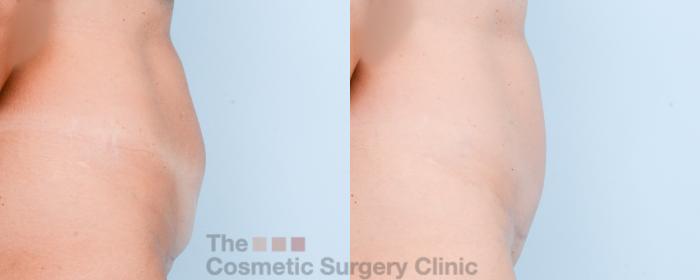Before & After Mini-Tummy Tuck Case 867 Right Side View in Waterloo, Ontario