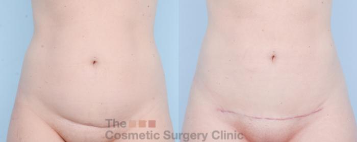 Before & After Mini-Tummy Tuck Case 892 Front View in Waterloo, Ontario