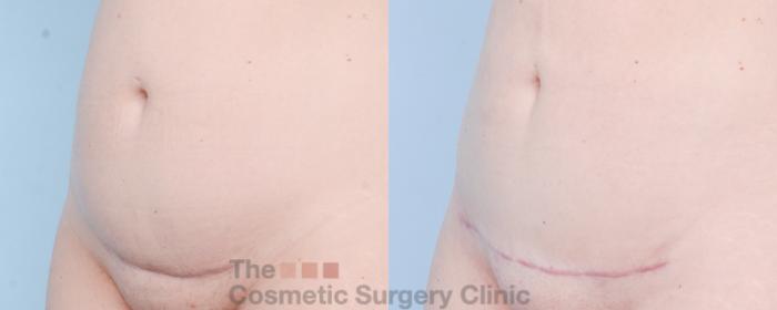 Before & After Mini-Tummy Tuck Case 892 Left Oblique View in Waterloo, Ontario