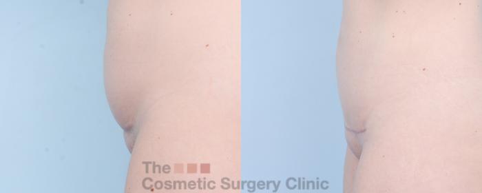 Before & After Mini-Tummy Tuck Case 892 Left Side View in Waterloo, Ontario