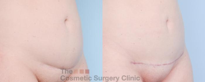 Before & After Mini-Tummy Tuck Case 892 Right Oblique View in Waterloo, Ontario