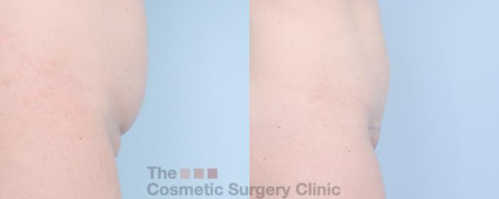 Before & After Mini-Tummy Tuck Case 892 Right Side View in Waterloo, Ontario
