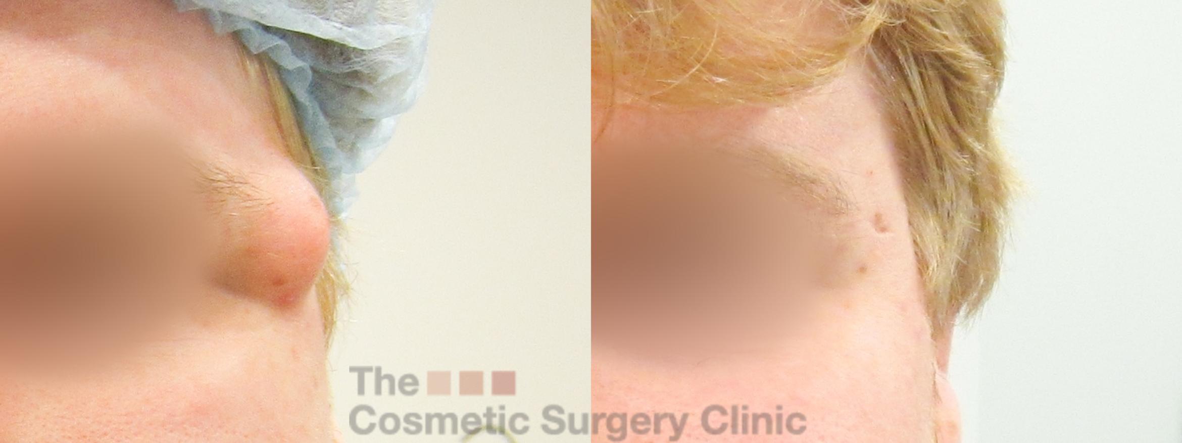 Before & After Minor Procedures Case 849 Front View in Waterloo, Ontario
