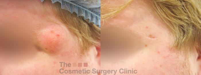 Before & After Minor Procedures Case 849 Left Side View in Waterloo, Ontario
