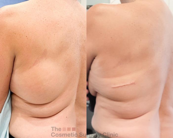 Before & After Mole & Lesion Removal Case 819 Left Oblique View in Waterloo, Ontario
