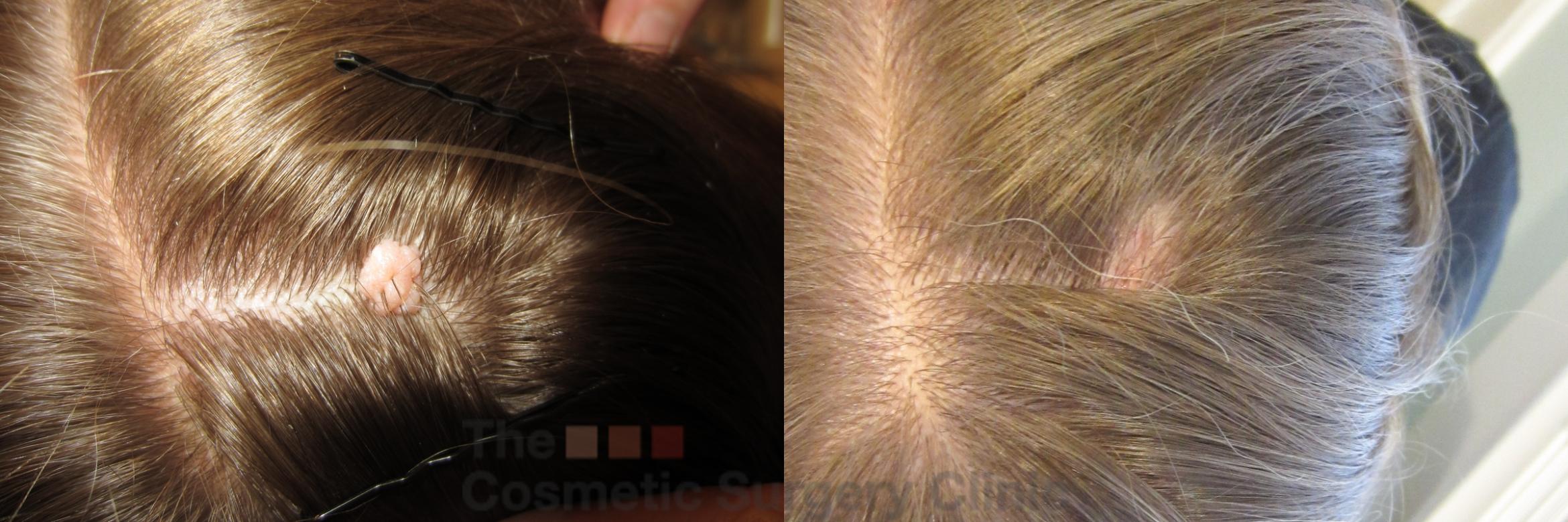 Before & After Mole & Lesion Removal Case 822 Head - View 1 View in Waterloo, Ontario