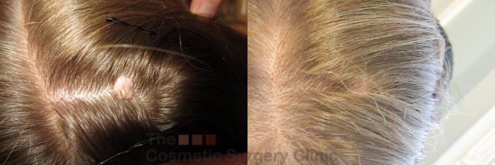 Before & After Mole & Lesion Removal Case 822 Head - View 2 View in Waterloo, Ontario