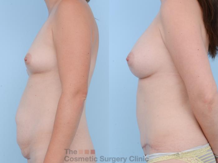 Before & After Mommy Makeover Case 297 View #2 View in Waterloo, Ontario
