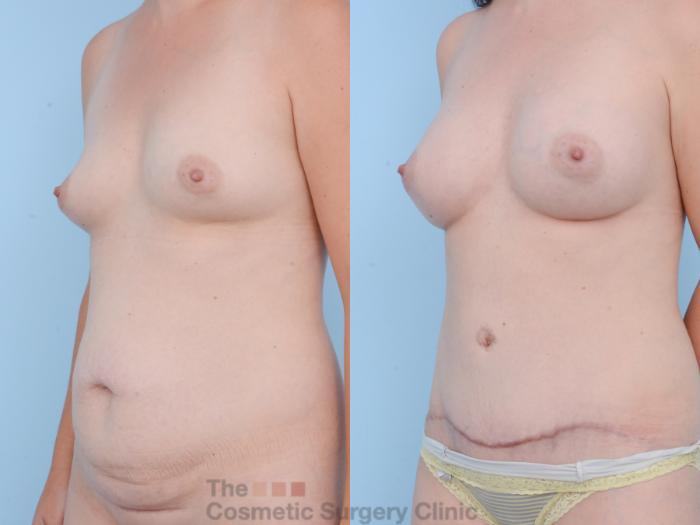 Before & After Mommy Makeover Case 297 View #3 View in Waterloo, Ontario