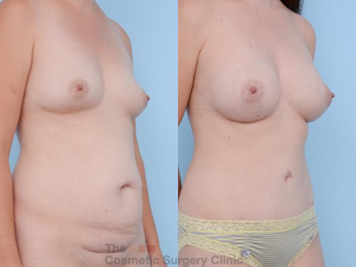Before & After Mommy Makeover Case 297 View #4 View in Waterloo, Ontario