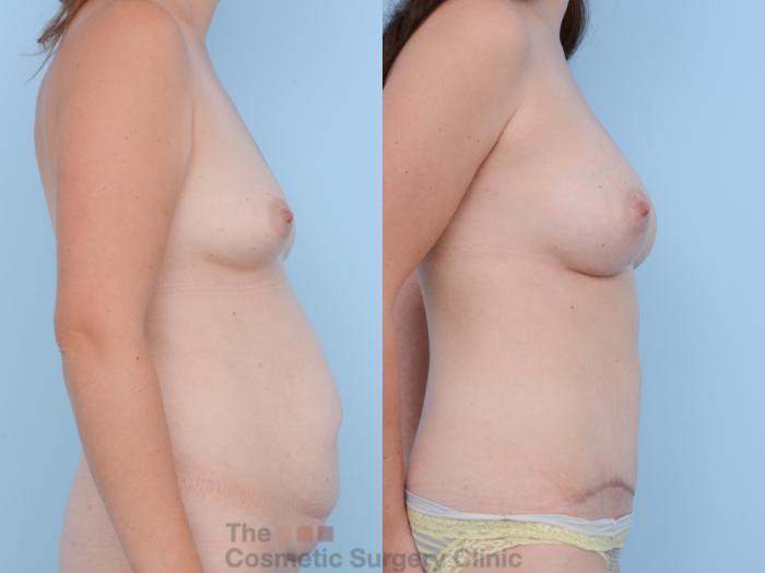 Before & After Mommy Makeover Case 297 View #5 View in Waterloo, Ontario