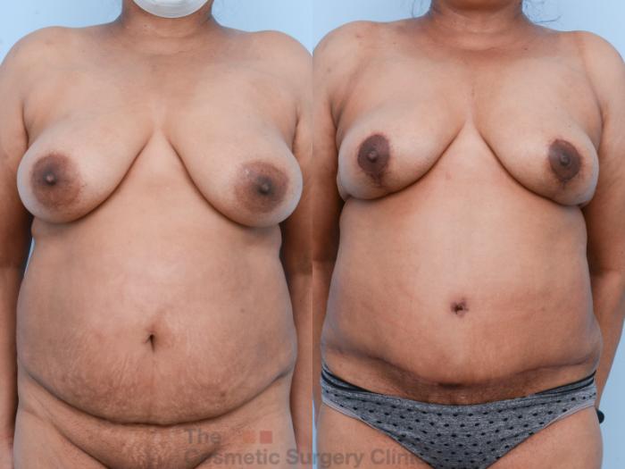 Before & After Mommy Makeover Case 539 View #1 View in Waterloo, Ontario