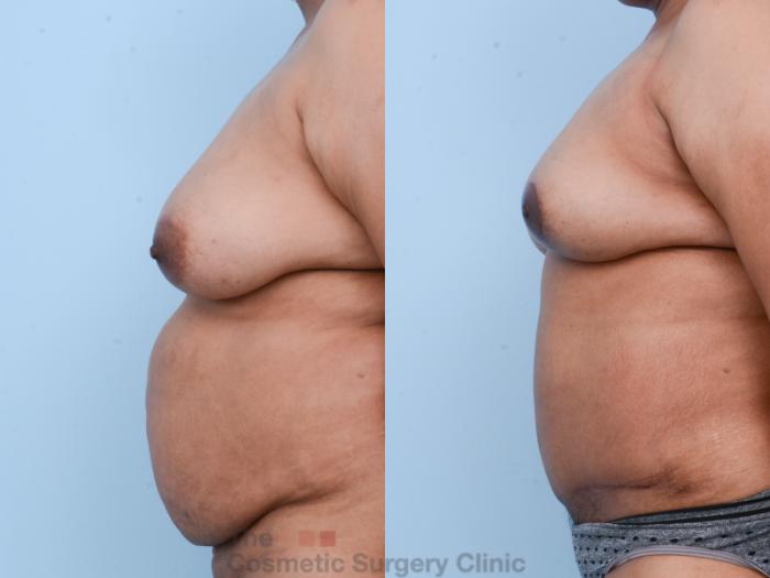 Before & After Mommy Makeover Case 539 View #2 View in Waterloo, Ontario