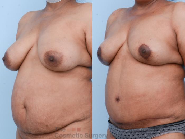 Before & After Mommy Makeover Case 539 View #3 View in Waterloo, Ontario
