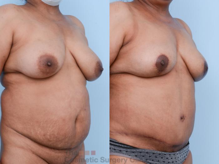 Before & After Mommy Makeover Case 539 View #4 View in Waterloo, Ontario