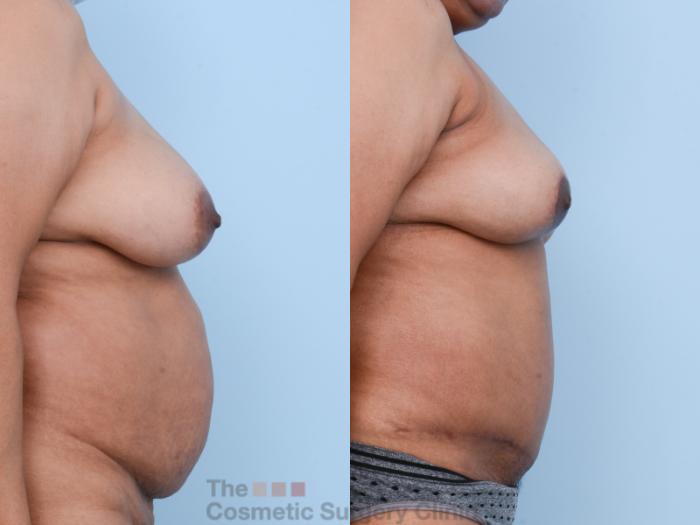 Before & After Mommy Makeover Case 539 View #5 View in Waterloo, Ontario