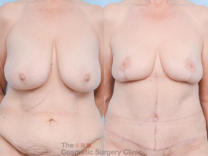 Before & After Mommy Makeover Case 809 Front View in Waterloo, Ontario