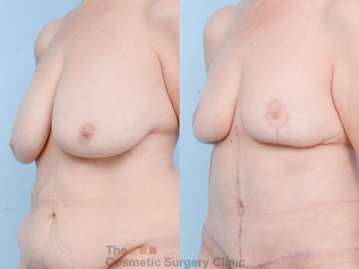 Before & After Mommy Makeover Case 809 Left Oblique View in Waterloo, Ontario