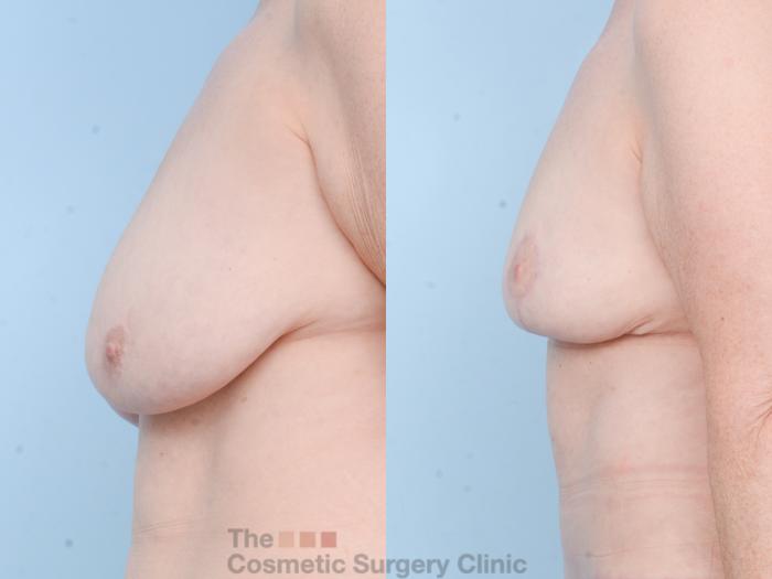 Before & After Mommy Makeover Case 809 Left Side View in Waterloo, Ontario