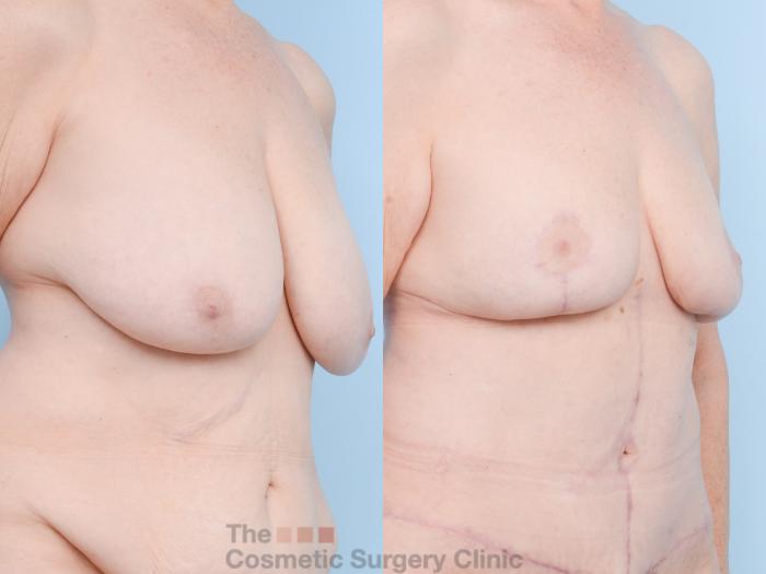 Before & After Mommy Makeover Case 809 Right Oblique View in Waterloo, Ontario