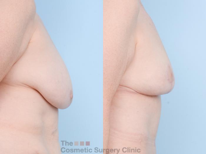 Before & After Mommy Makeover Case 809 Right Side View in Waterloo, Ontario