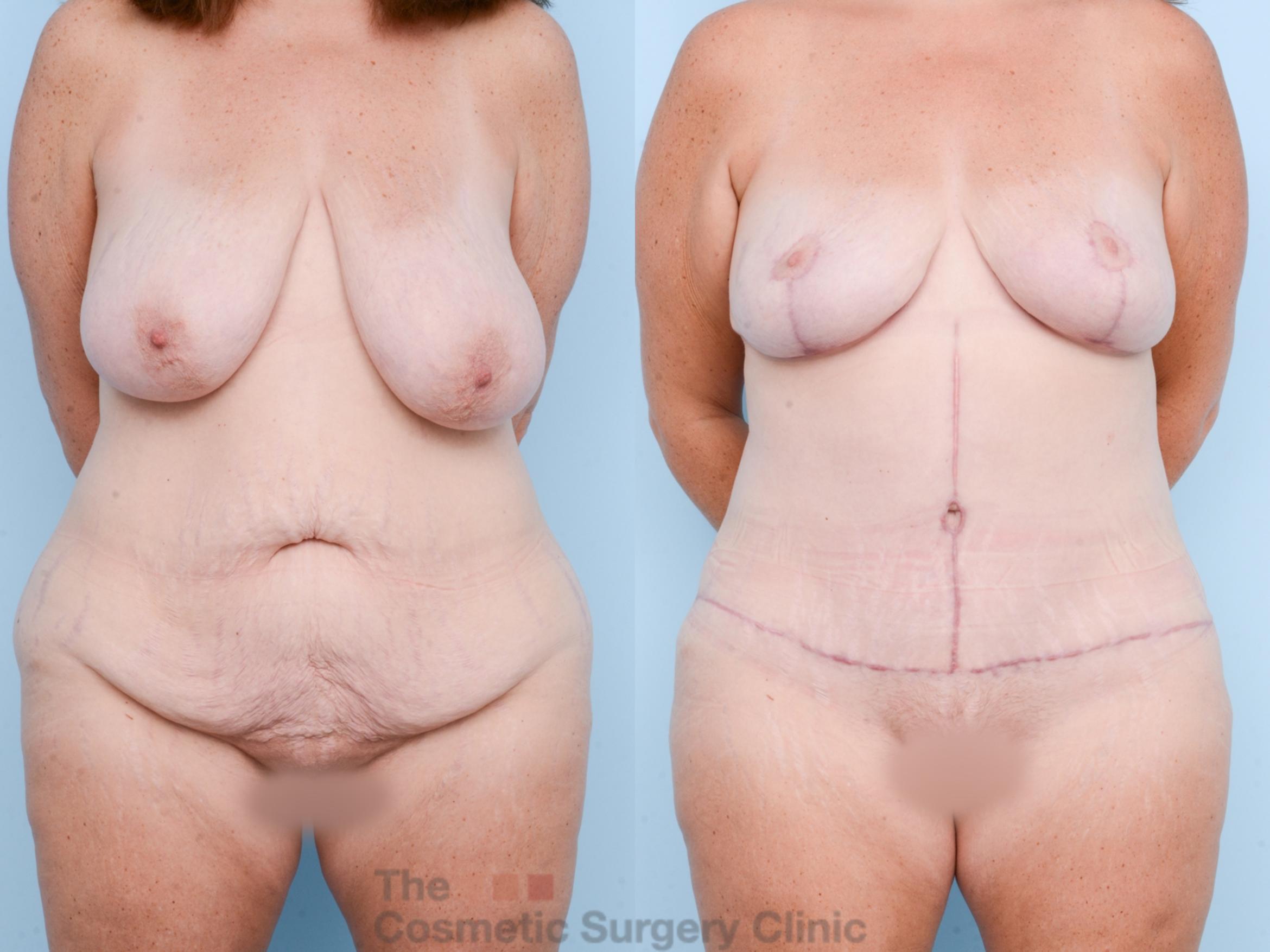 Before & After Mommy Makeover Case 826 Front View in Waterloo, Ontario