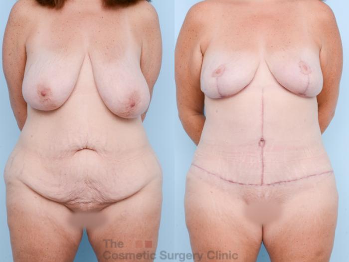 Before & After Mommy Makeover Case 826 Front View in Waterloo, Ontario