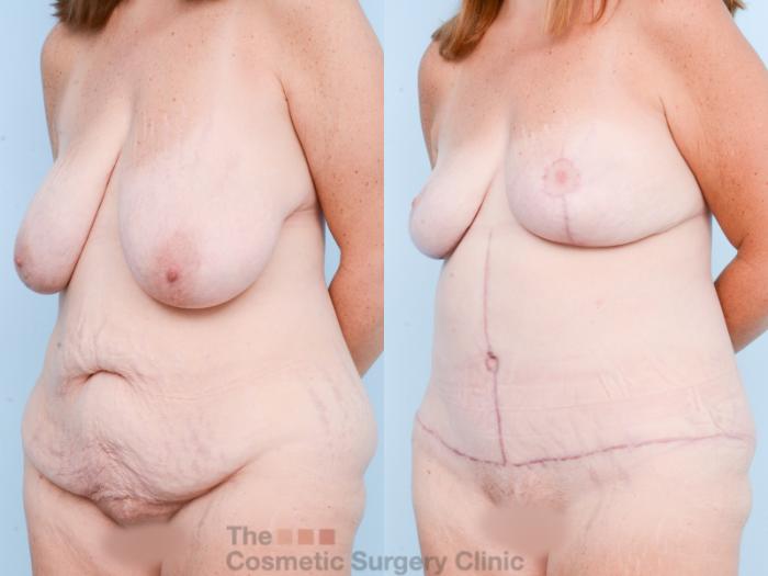 Before & After Mommy Makeover Case 826 Left Oblique View in Waterloo, Ontario