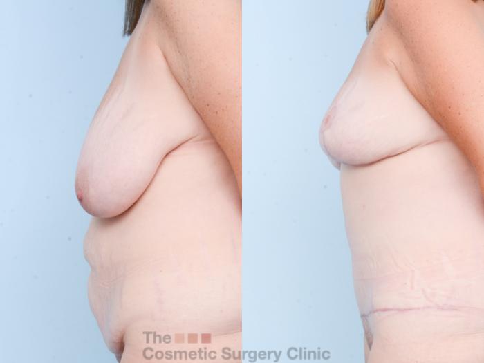 Before & After Mommy Makeover Case 826 Left Side View in Waterloo, Ontario