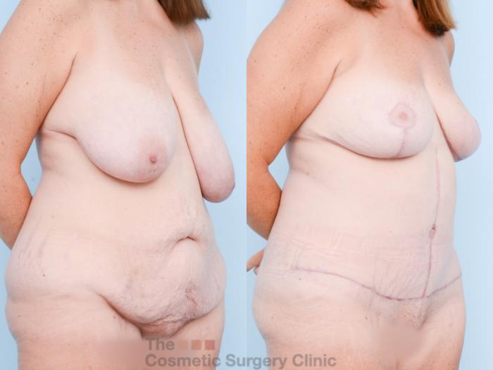 Before & After Mommy Makeover Case 826 Right Oblique View in Waterloo, Ontario