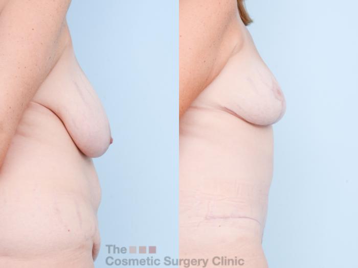Before & After Mommy Makeover Case 826 Right Side View in Waterloo, Ontario