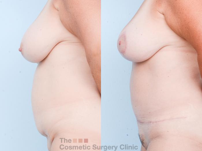 Before & After Mommy Makeover Case 833 Left Side View in Waterloo, Ontario