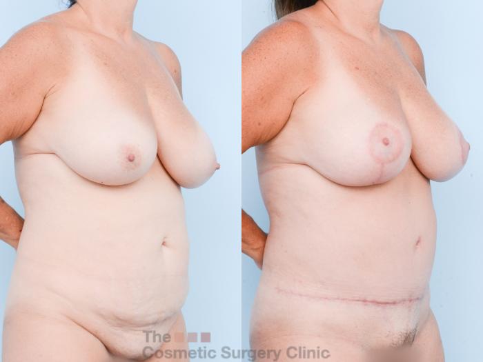Before & After Mommy Makeover Case 833 Right Oblique View in Waterloo, Ontario