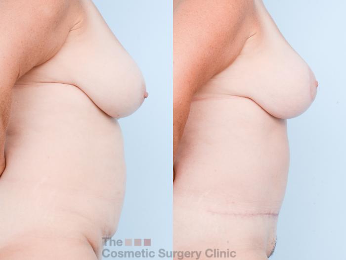 Before & After Mommy Makeover Case 833 Right Side View in Waterloo, Ontario