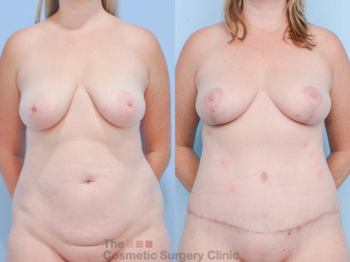 Before & After Mommy Makeover Case 855 Front View in Waterloo, Ontario