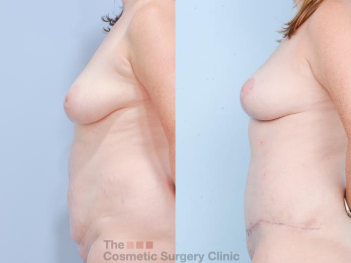 Before & After Mommy Makeover Case 855 Left Side View in Waterloo, Ontario