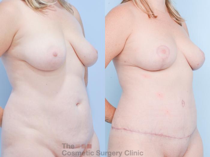 Before & After Mommy Makeover Case 855 Right Oblique View in Waterloo, Ontario