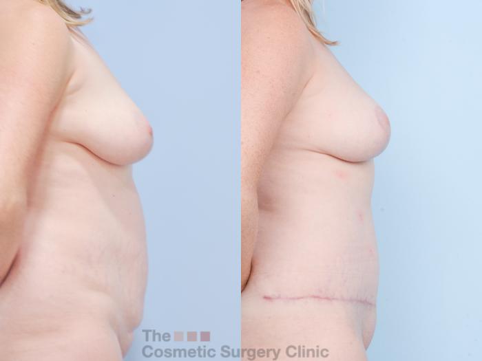 Before & After Mommy Makeover Case 855 Right Side View in Waterloo, Ontario