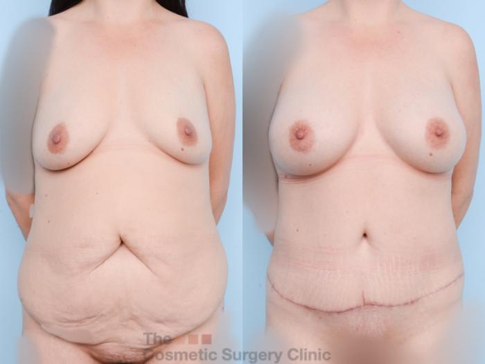 Before & After Mommy Makeover Case 857 Front View in Waterloo, Ontario