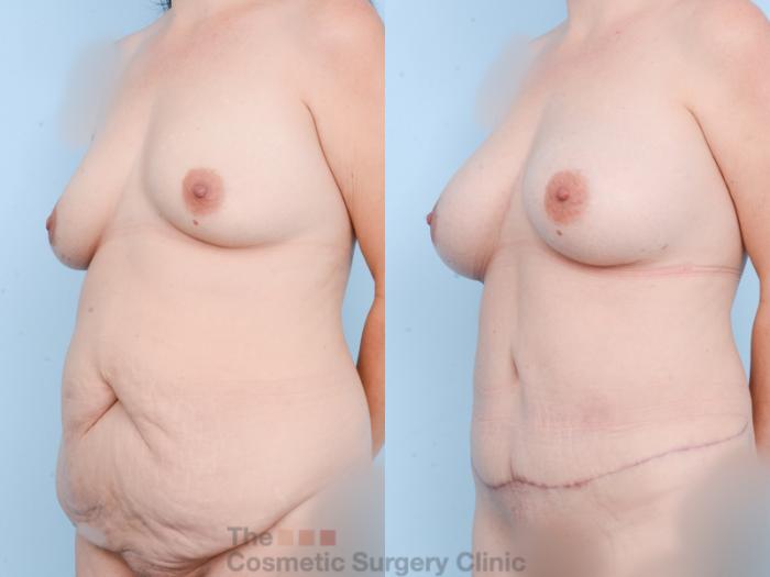 Before & After Mommy Makeover Case 857 Left Oblique View in Waterloo, Ontario