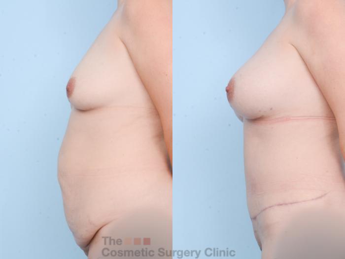 Before & After Mommy Makeover Case 857 Left Side View in Waterloo, Ontario