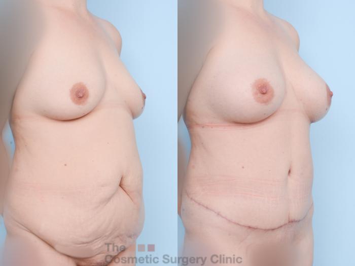 Before & After Mommy Makeover Case 857 Right Oblique View in Waterloo, Ontario