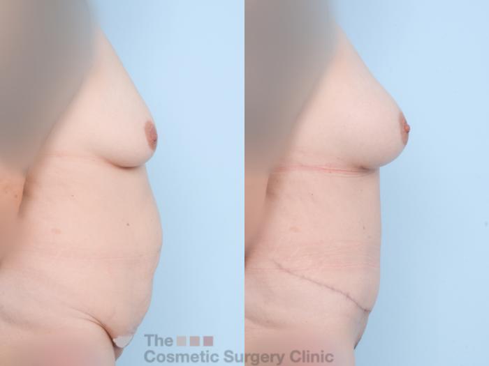 Before & After Mommy Makeover Case 857 Right Side View in Waterloo, Ontario