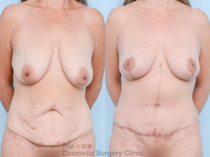 Before & After Mommy Makeover Case 873 Front View in Waterloo, Ontario