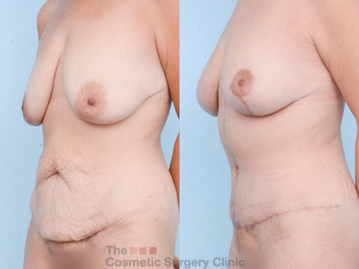 Before & After Mommy Makeover Case 873 Left Oblique View in Waterloo, Ontario