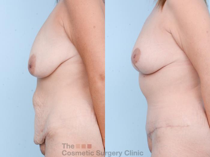 Before & After Mommy Makeover Case 873 Left Side View in Waterloo, Ontario