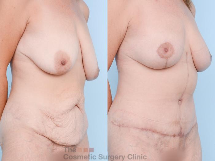 Before & After Mommy Makeover Case 873 Right Oblique View in Waterloo, Ontario