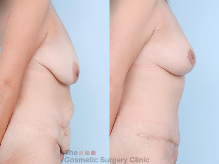 Before & After Mommy Makeover Case 873 Right Side View in Waterloo, Ontario