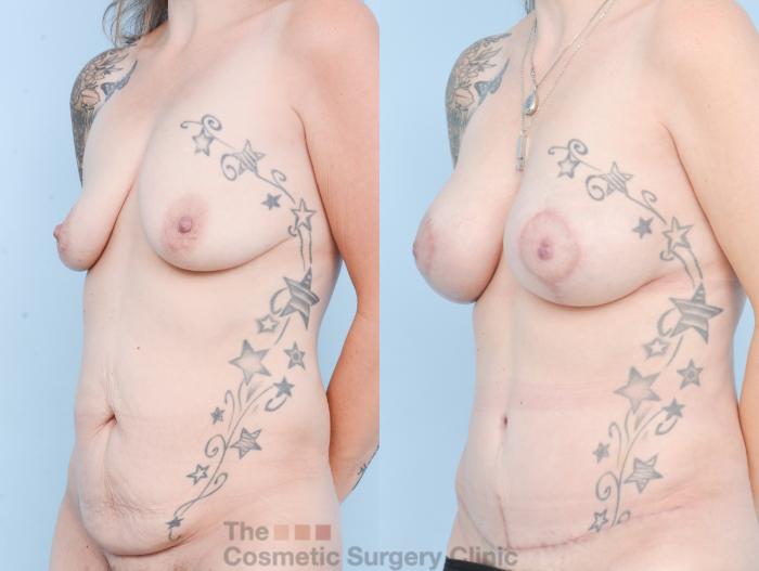 Before & After Mommy Makeover Case 878 Left Oblique View in Waterloo, Ontario